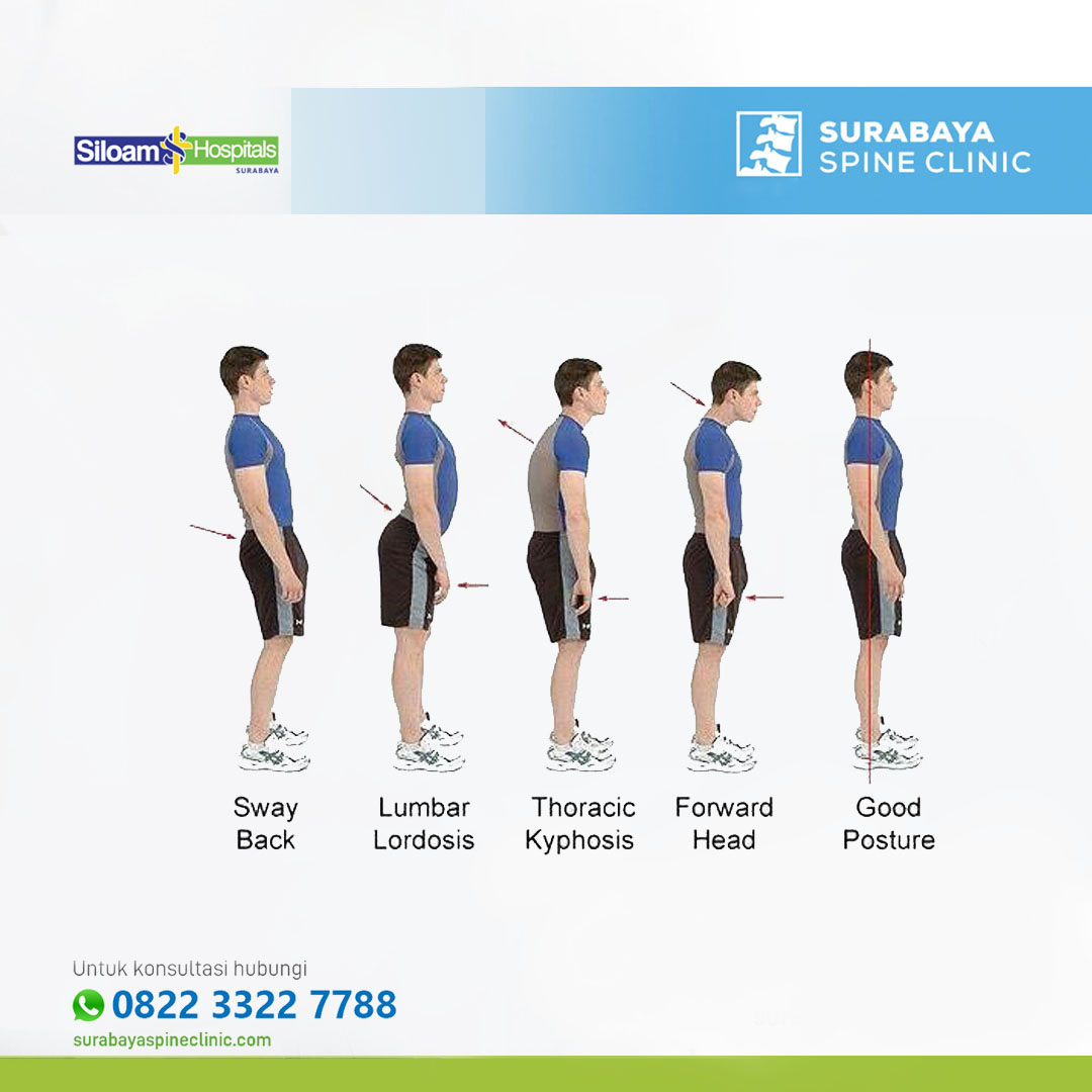 The Importance of Maintaining a Normal Spine Shape for Optimal Health and Well-being